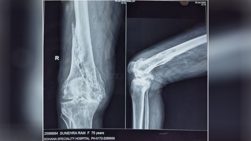 Dr. Gagandeep Sachdeva and Team Successfully Perform Robotic Knee Replacement Surgery